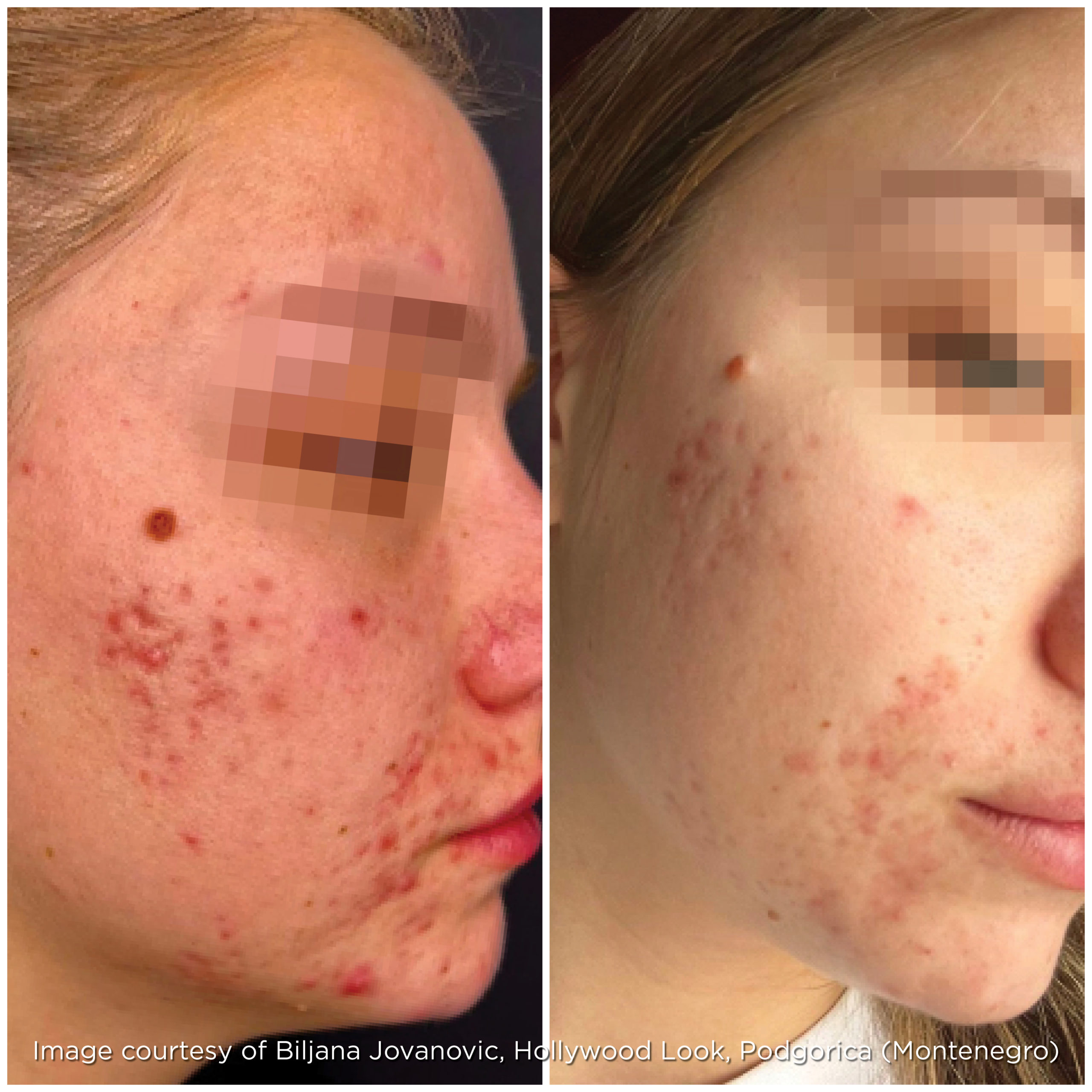 Acne - Microneedling