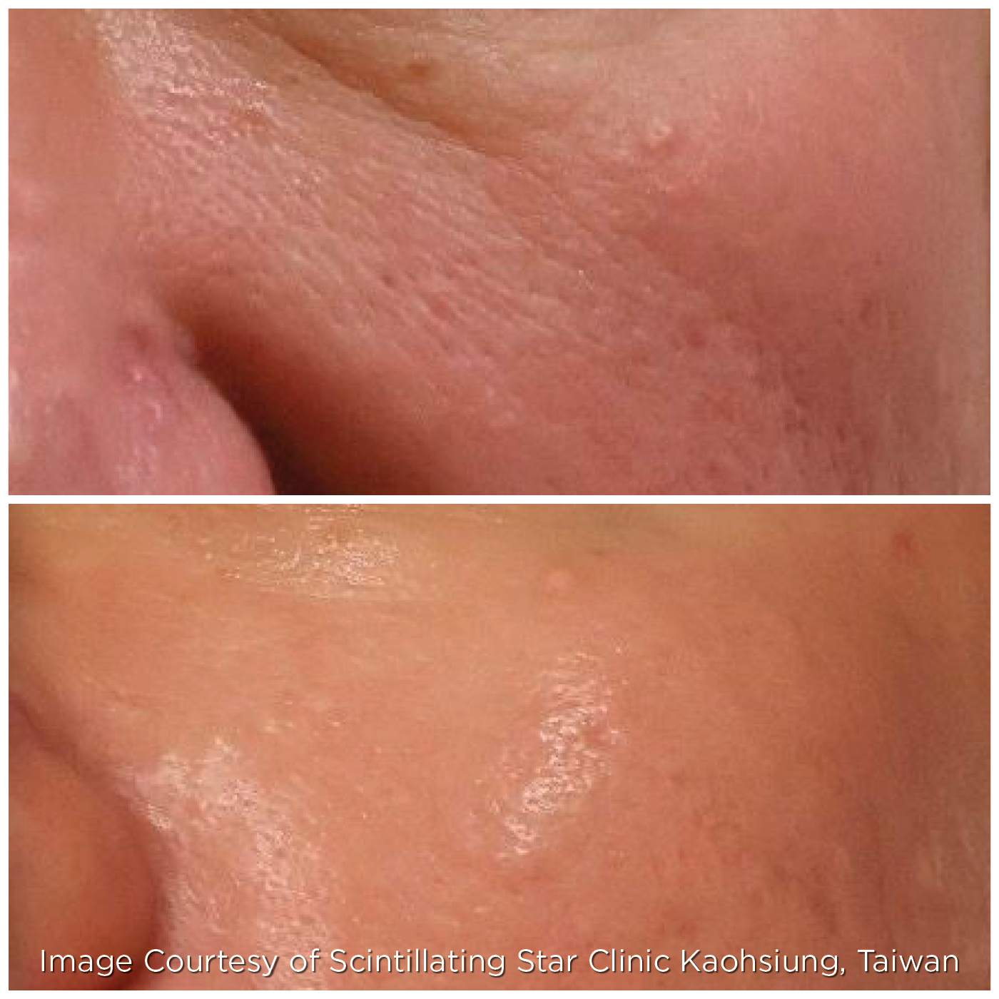 Ageing - Microneedling