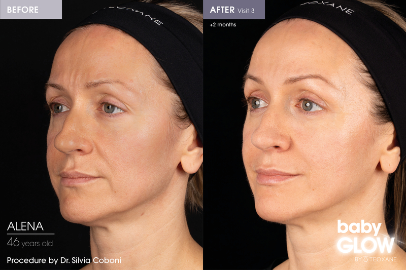 Skin quality - Skin Boosters