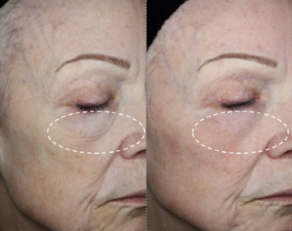 Ageing eyes - Exosomes