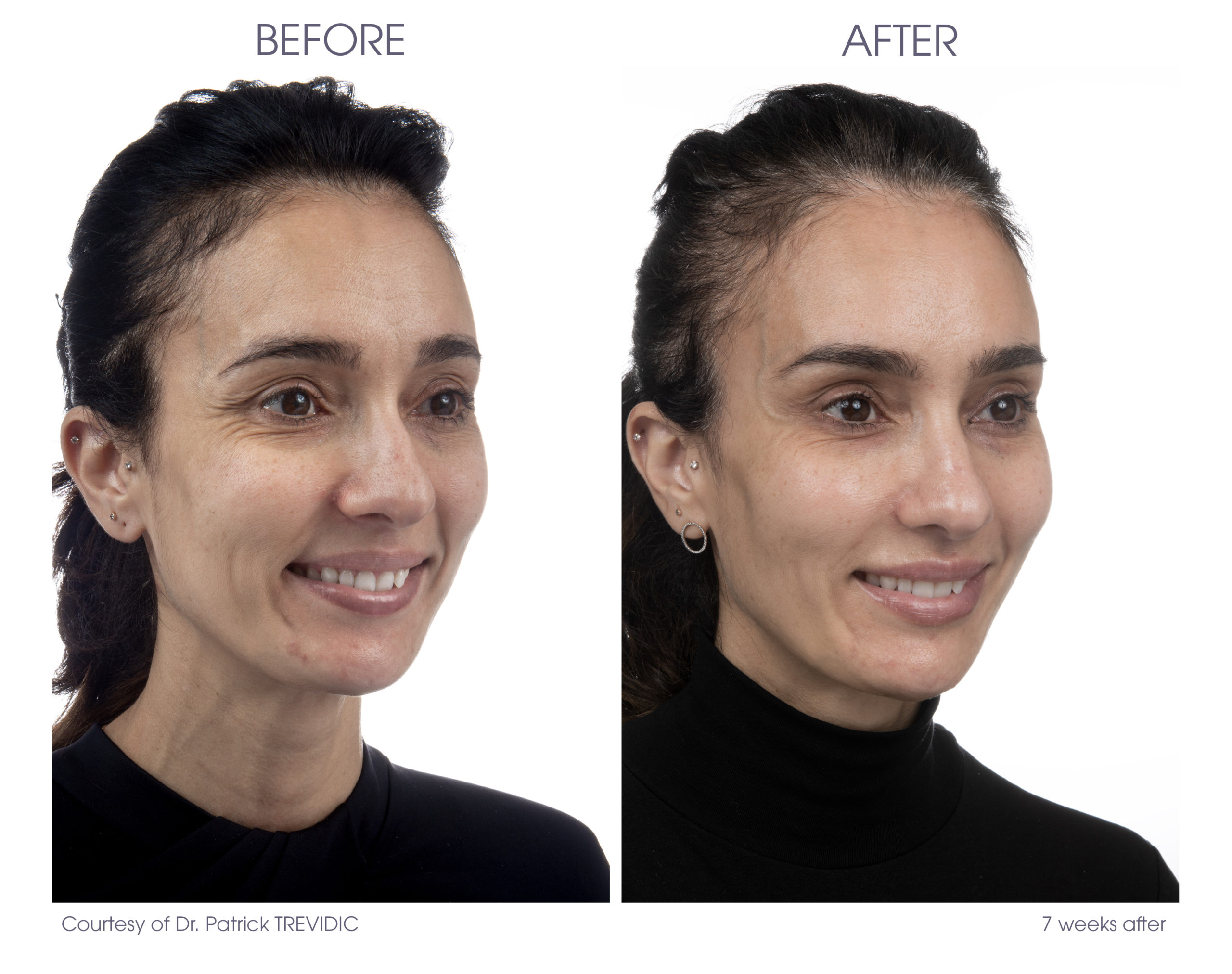 Signs of Ageing - Dermal Fillers