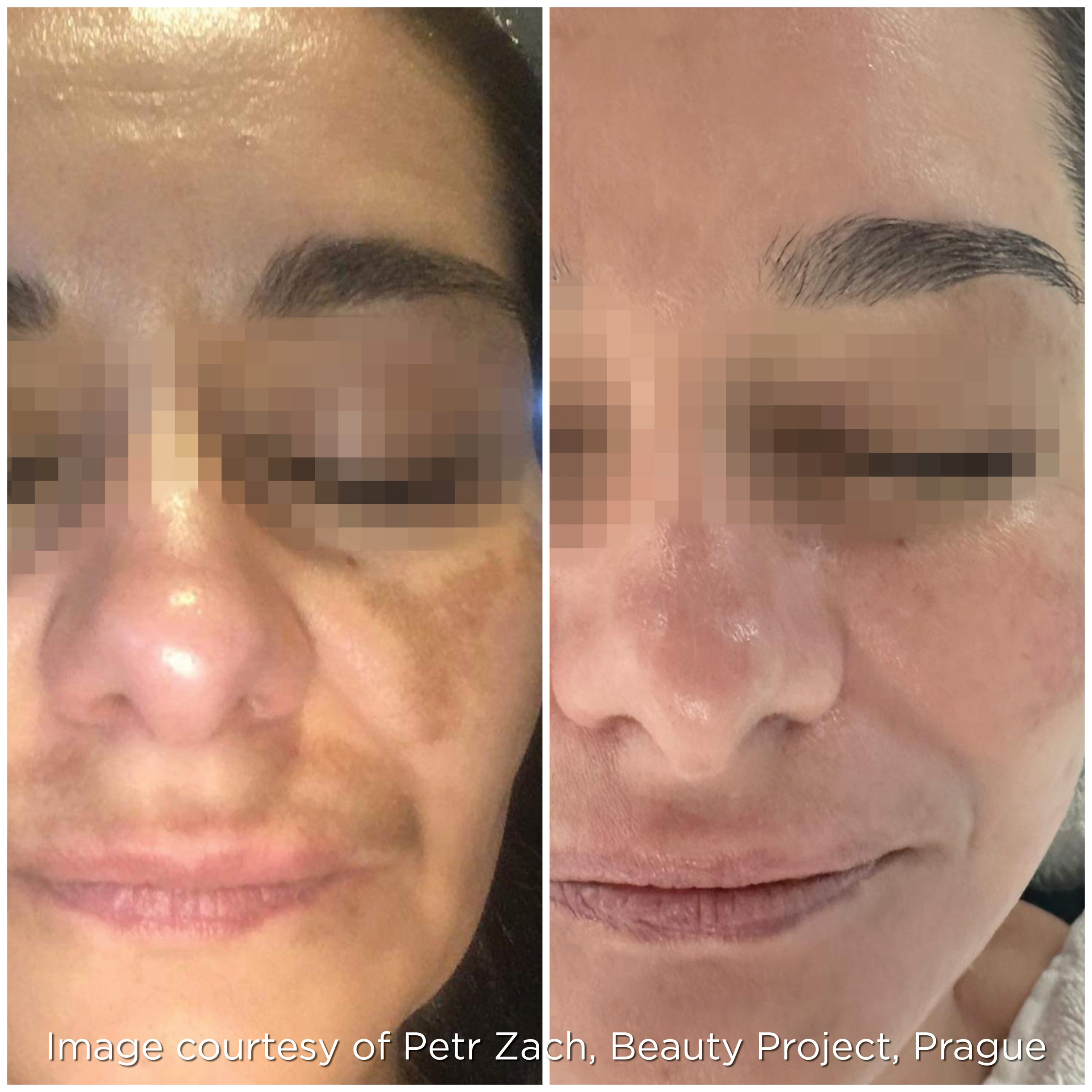 Melasma - Microneedling