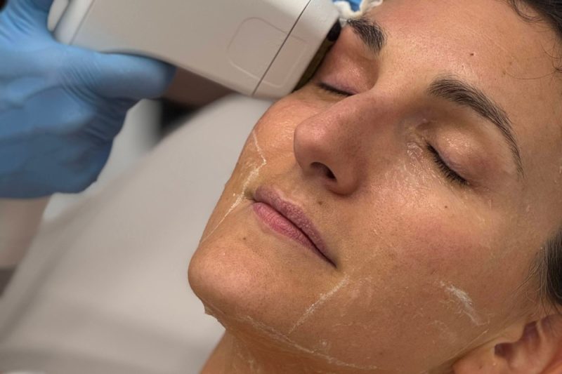 SOFWAVE FOR THE EYE AREA: A NON-SURGICAL APPROACH TO DROOPY EYELIDS