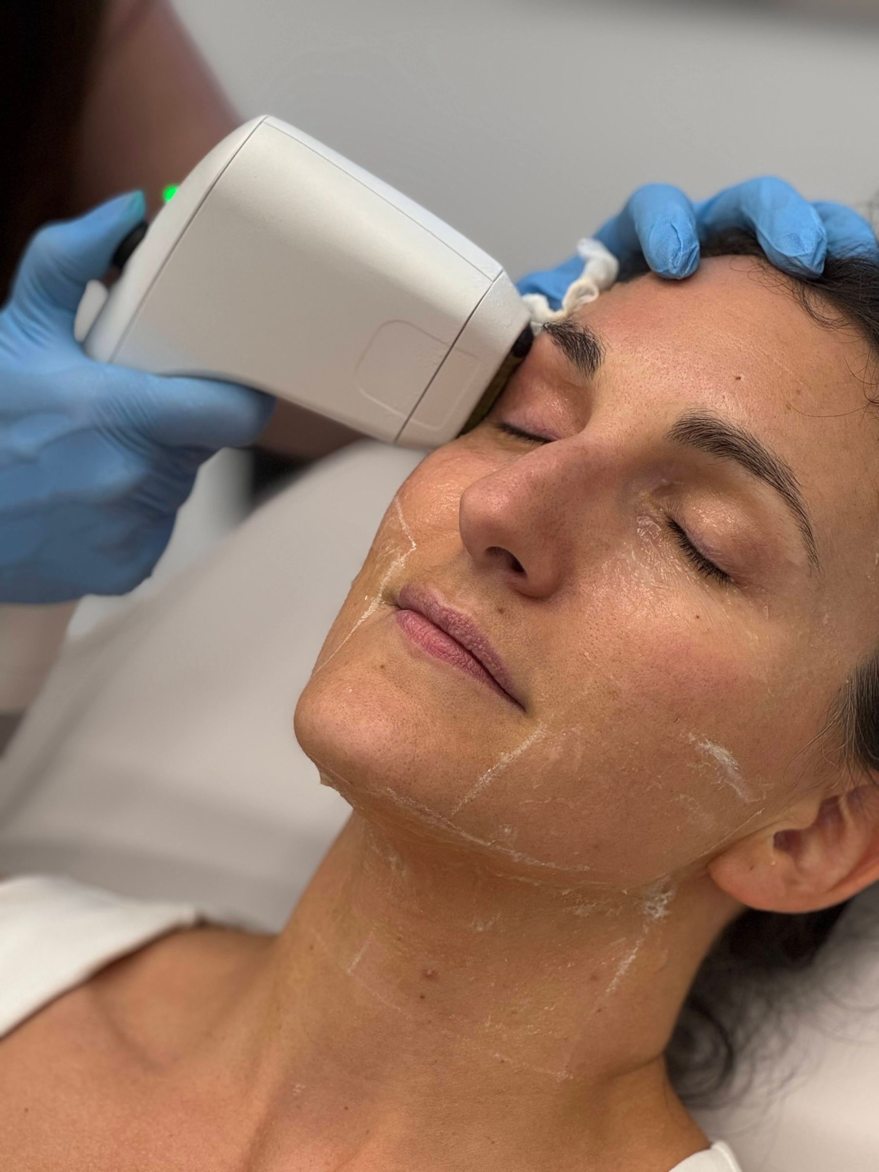 SOFWAVE FOR THE EYE AREA: A NON-SURGICAL APPROACH TO DROOPY EYELIDS