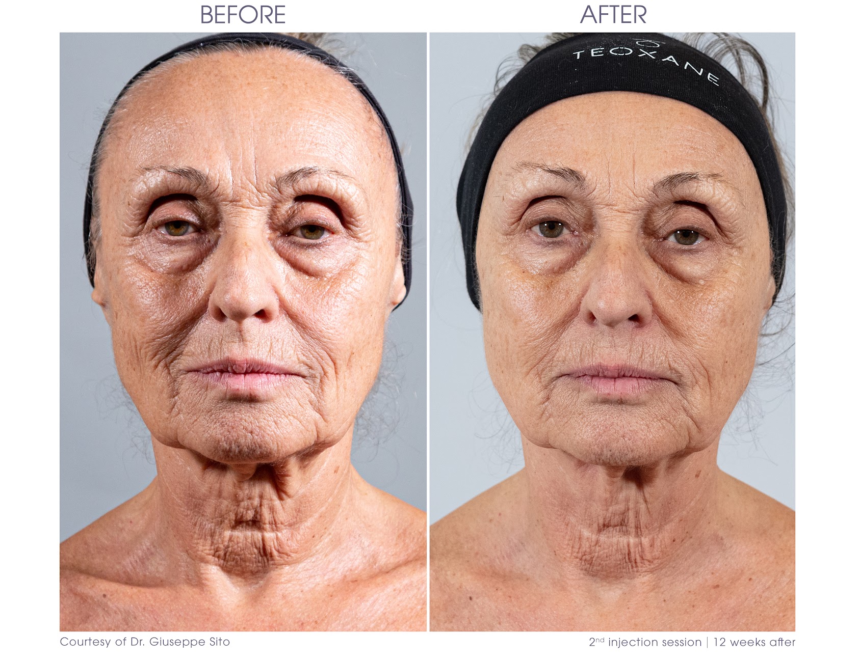 Signs of Ageing - Skin Boosters