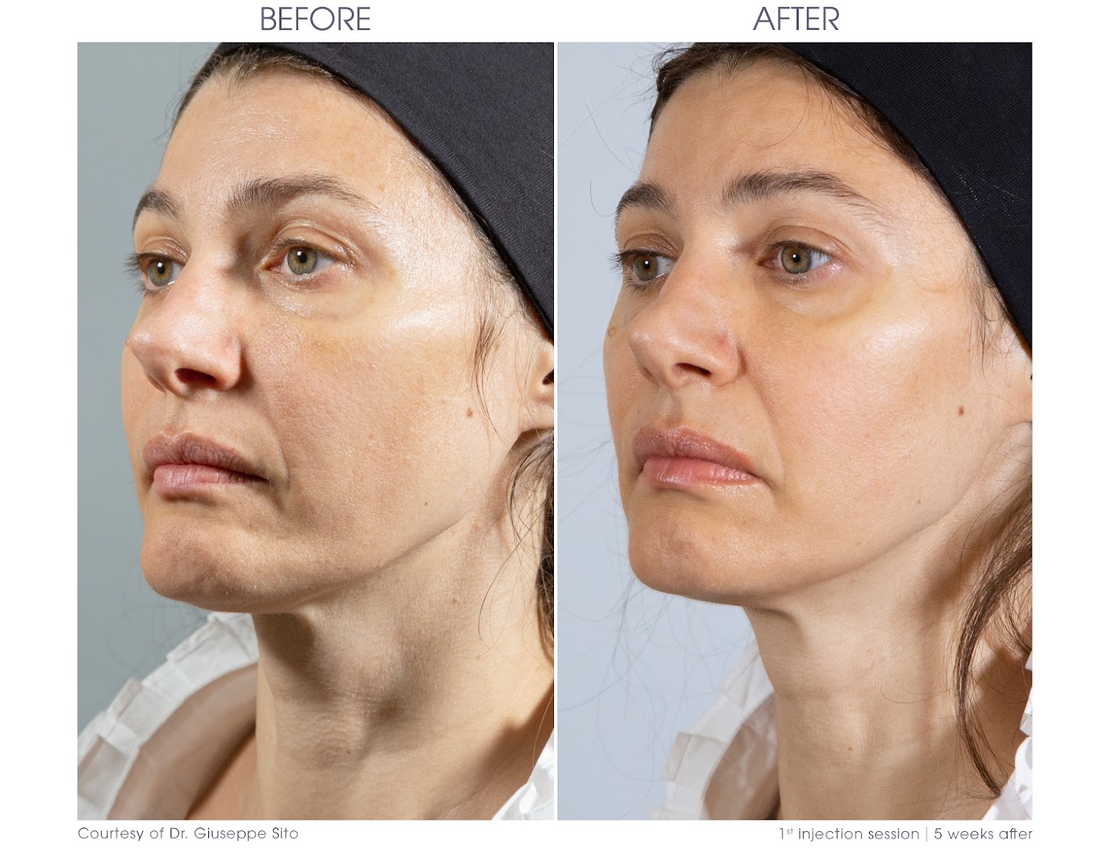 Skin tightness - Skin Boosters