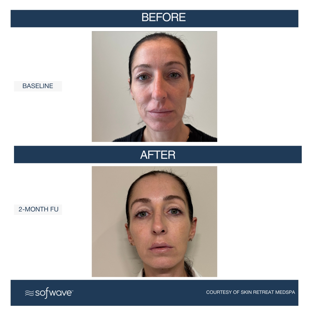 Lower Face & Eyebrows - Sofwave