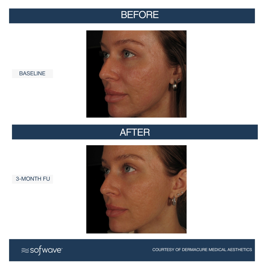 Acne Scars - Sofwave