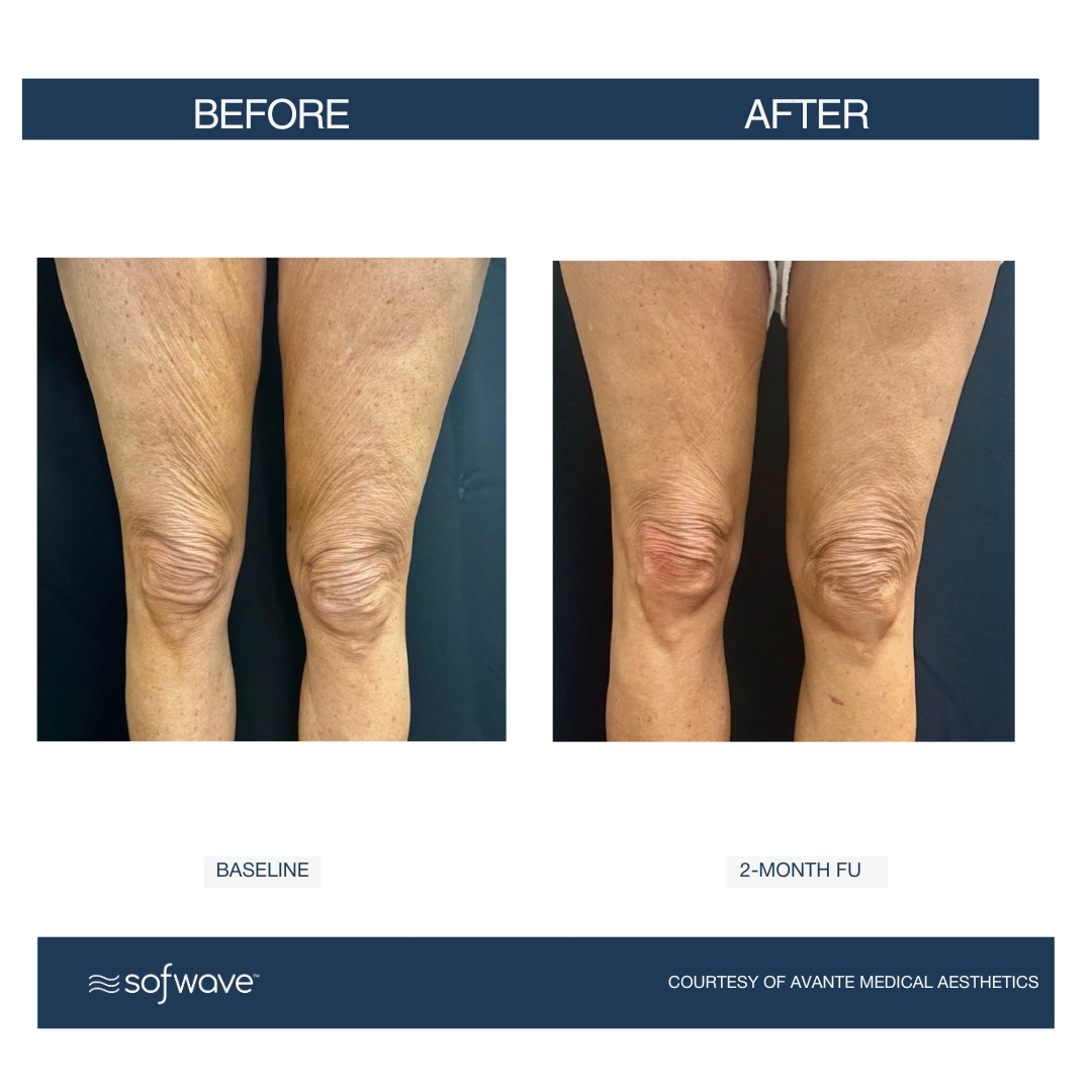 Cellulite - Sofwave