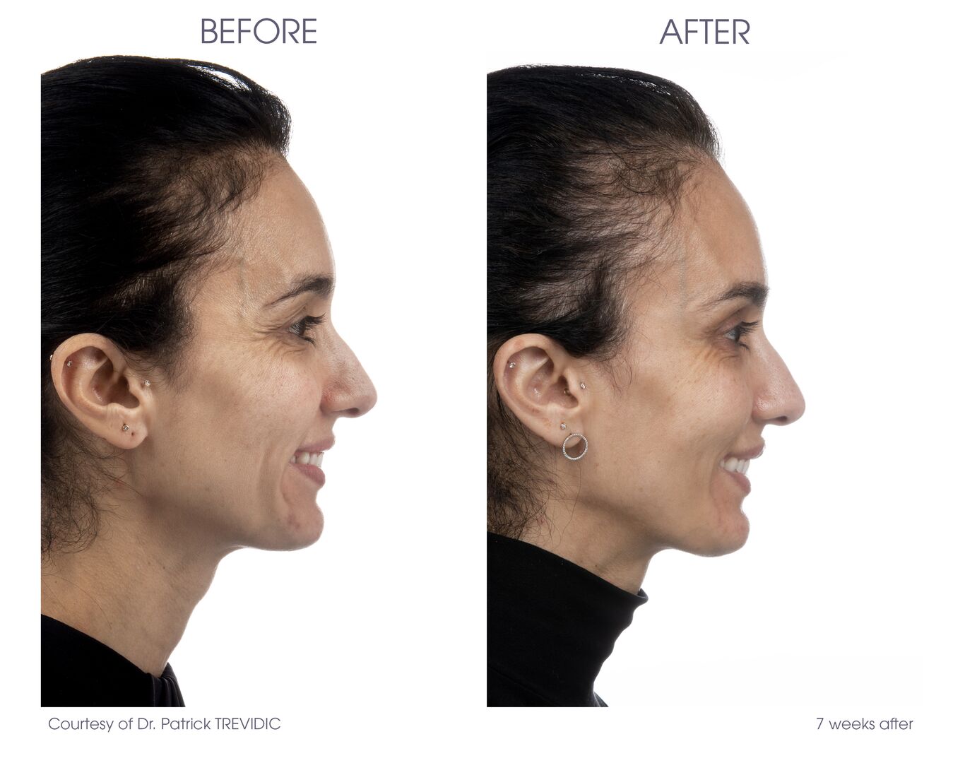 Skin Tightness - Dermal Fillers