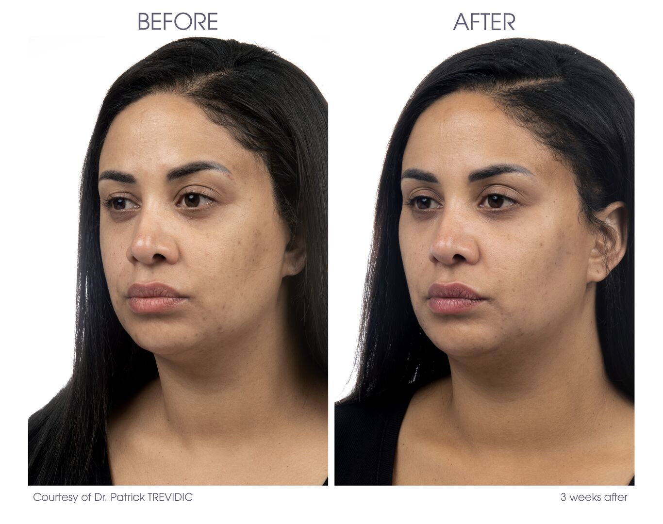 Loss of Volume - Dermal Fillers