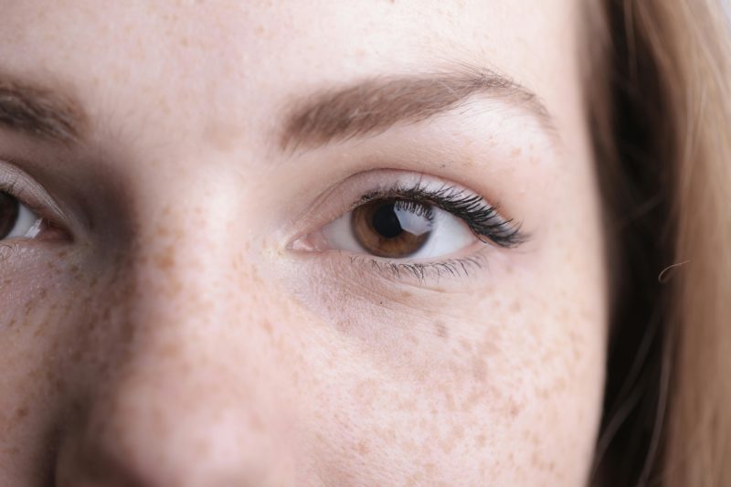 MELASMA: WHAT IT IS, WHY IT HAPPENS, AND HOW IT CAN BE TREATED