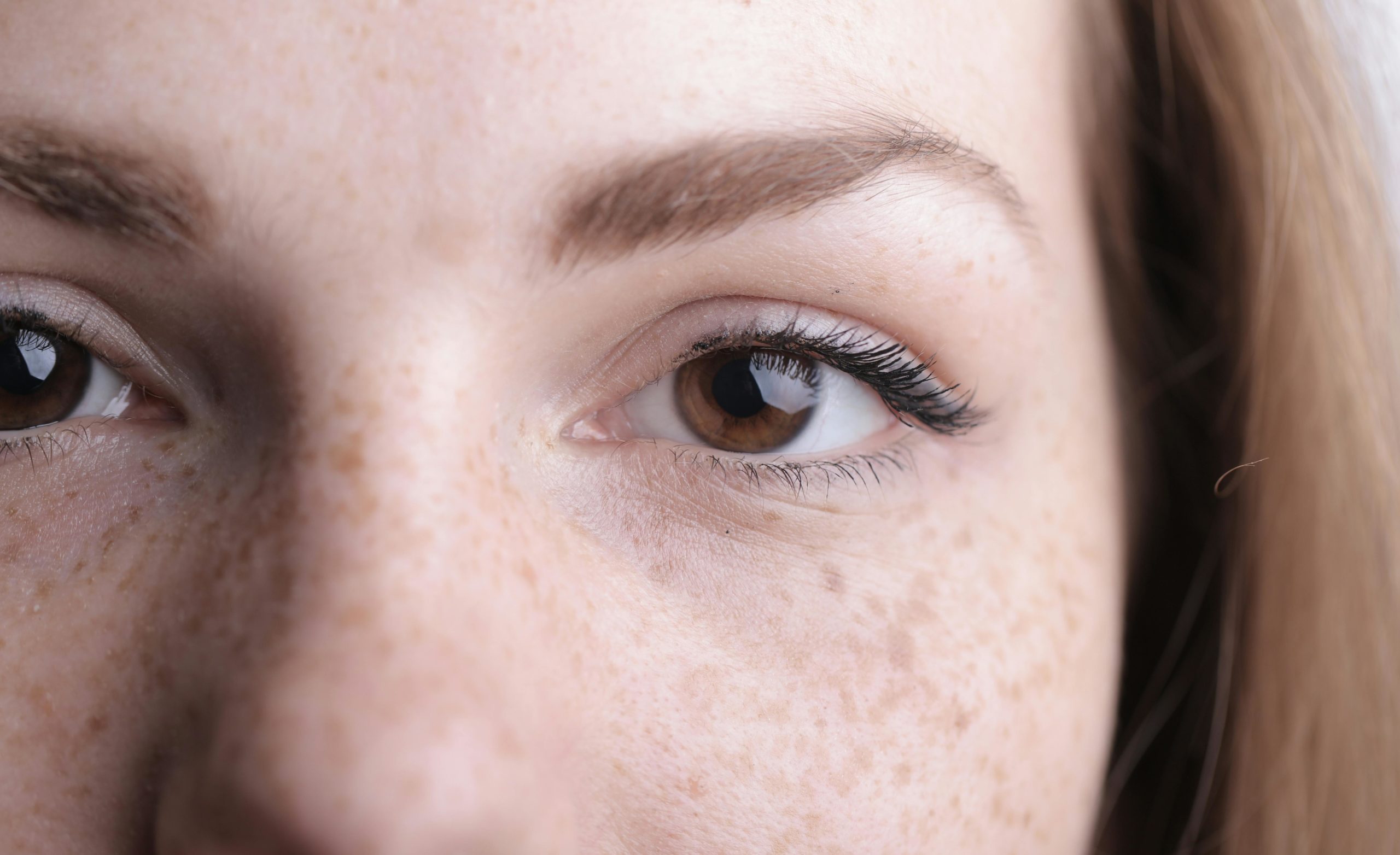 MELASMA: WHAT IT IS, WHY IT HAPPENS, AND HOW IT CAN BE TREATED