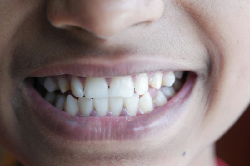 BRUXISM (TEETH GRINDING): CAUSES, SYMPTOMS AND MODERN TREATMENT OPTIONS