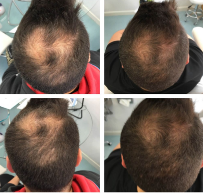 Hair Loss - Polynucleotides