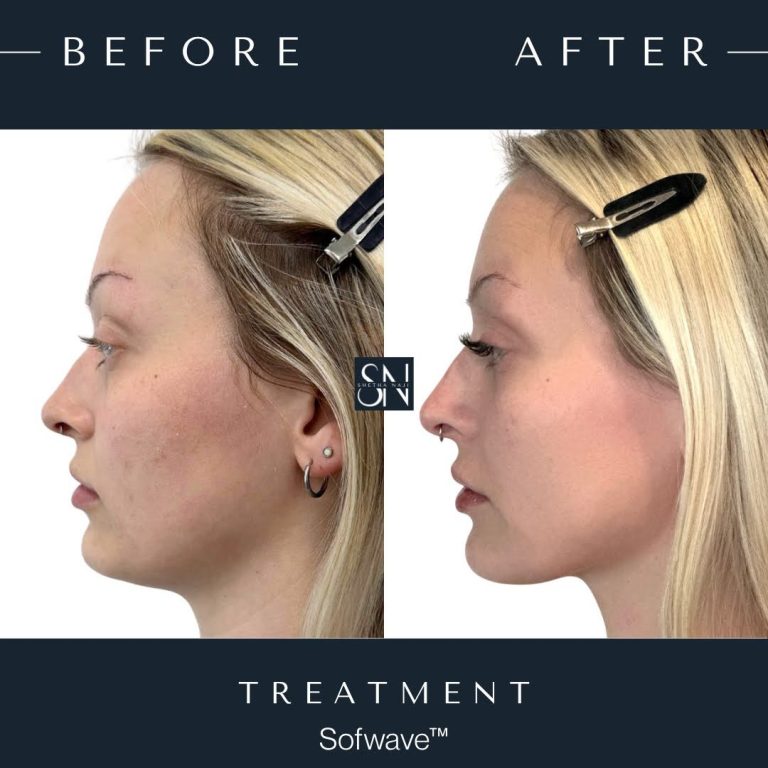 Patient C's Sofwave™ Journey progression photo 1