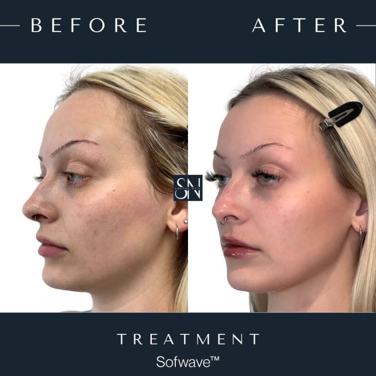 Patient C's Sofwave™ Journey progression photo 2