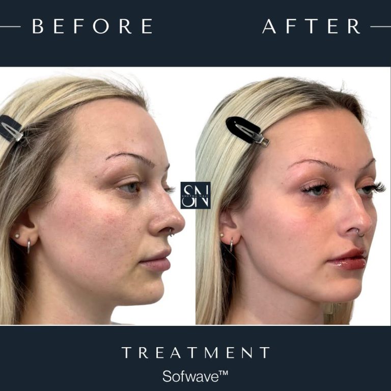 Patient C's Sofwave™ Journey progression photo 3