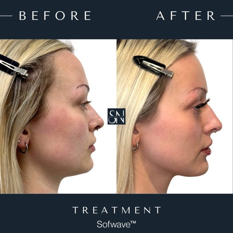 Patient C's Sofwave™ Journey progression photo 4