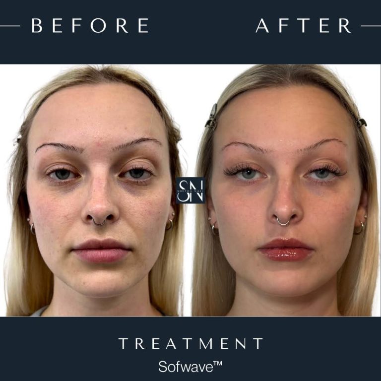 Patient C's Sofwave™ Journey progression photo 5