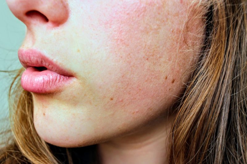 INTERNATIONAL SKIN PIGMENTATION DAY: UNDERSTANDING & TREATING UNEVEN SKIN TONE